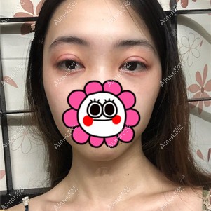 在重庆美圣美邦做双眼皮修复半个月 在重庆美圣美邦做双眼皮修复半个月