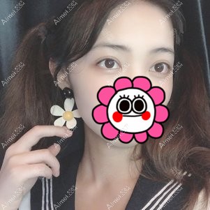 在重庆美圣美邦做双眼皮修复3个月 在重庆美圣美邦做双眼皮修复3个月