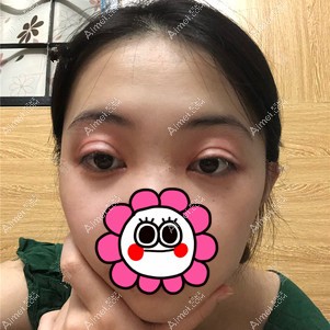 在重庆美圣美邦做双眼皮修复后7天 在重庆美圣美邦做双眼皮修复后7天