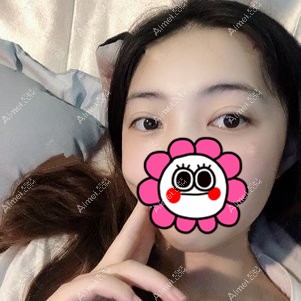 在重庆美圣美邦做双眼皮修复1个月 在重庆美圣美邦做双眼皮修复1个月