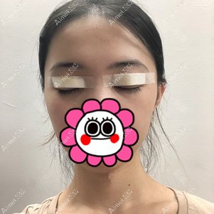 在重庆美圣美邦做双眼皮修复当天 在重庆美圣美邦做双眼皮修复当天