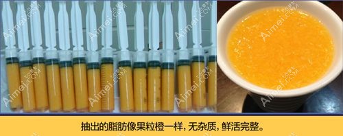 杨佳琦医生做自体脂肪丰胸注入的脂肪纯度高.jpg 杨佳琦医生做自体脂肪丰胸注入的脂肪纯度高.jpg