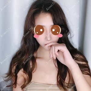 在重庆铂生做鼻综合术后45天 在重庆铂生做鼻综合术后45天