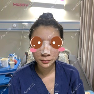 在重庆铂生做鼻综合术后1天 在重庆铂生做鼻综合术后1天
