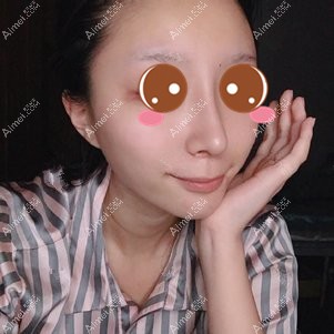 在重庆铂生做鼻综合术后7天 在重庆铂生做鼻综合术后7天