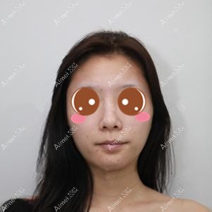 在重庆铂生做鼻综合术前 在重庆铂生做鼻综合术前