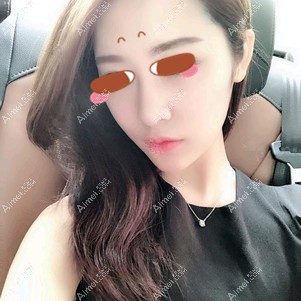 找田永华做耳软骨隆鼻术后118天 找田永华做耳软骨隆鼻术后118天