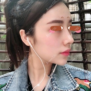 找田永华做耳软骨隆鼻术后一个月 找田永华做耳软骨隆鼻术后一个月