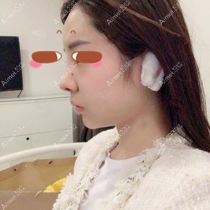 找田永华做耳软骨隆鼻术后4天 找田永华做耳软骨隆鼻术后4天