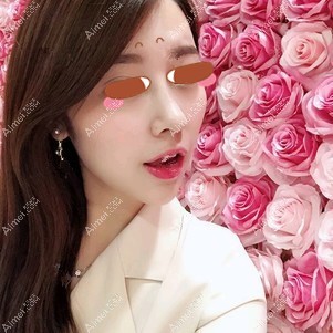 找田永华做耳软骨隆鼻术后54天 找田永华做耳软骨隆鼻术后54天