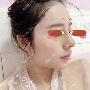 找田永华做耳软骨隆鼻术后9天 找田永华做耳软骨隆鼻术后9天