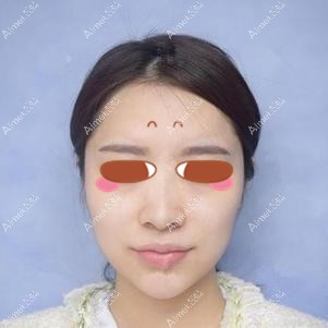 找田永华做耳软骨隆鼻术前 找田永华做耳软骨隆鼻术前