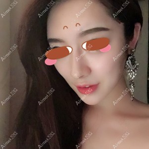 找田永华做耳软骨隆鼻术后半年 找田永华做耳软骨隆鼻术后半年