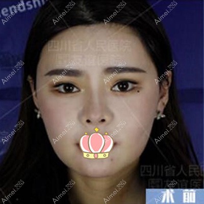 四川友谊医院整形美容科面部吸脂案例 四川友谊医院整形美容科面部吸脂案例