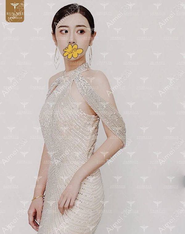 张红芳院长做的自体脂肪填充案例5年效果图.jpg 张红芳院长做的自体脂肪填充案例5年效果图.jpg