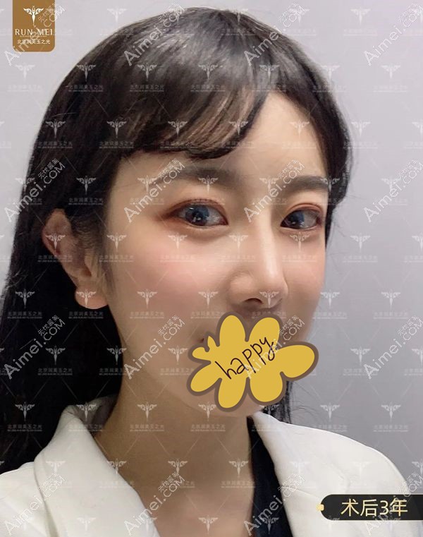 北京润美玉之光张红芳院长做的脂肪填充全脸术后3年效果.jpg 北京润美玉之光张红芳院长做的脂肪填充全脸术后3年效果.jpg