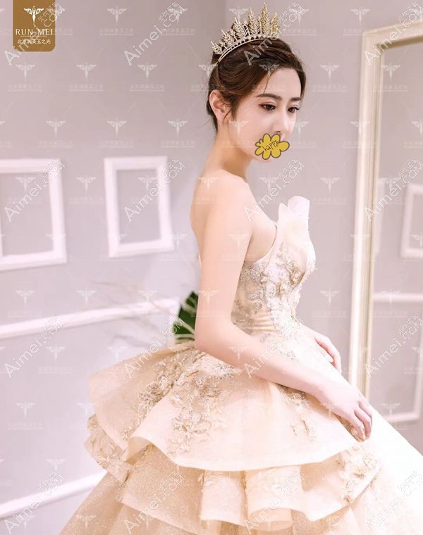 自体脂肪填充面部5年效果稳定.jpg 自体脂肪填充面部5年效果稳定.jpg