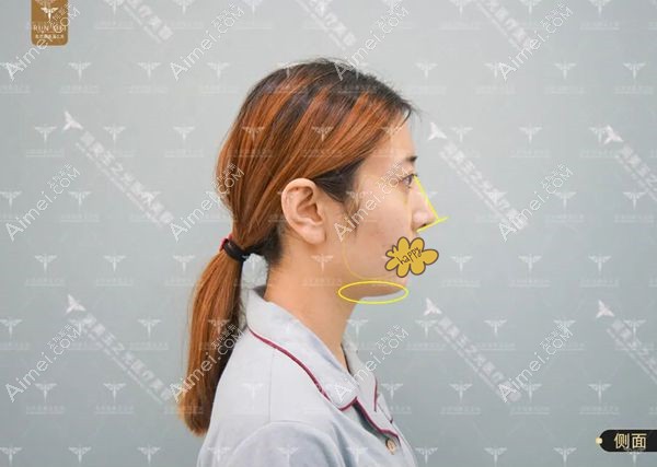 张红芳博士设计的填充下巴和溶脂前照片.jpg 张红芳博士设计的填充下巴和溶脂前照片.jpg