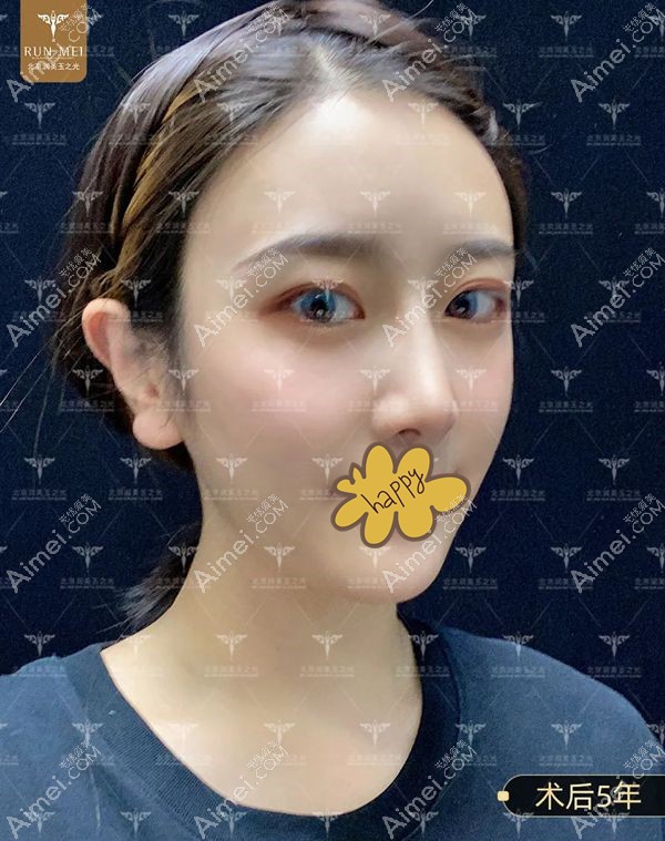 北京润美玉之光自体脂肪填充全脸术后5年效果图.jpg 北京润美玉之光自体脂肪填充全脸术后5年效果图.jpg