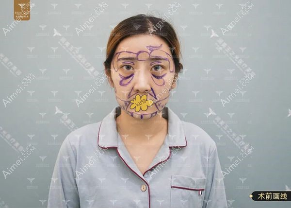 张红芳院长做的面部脂肪填充50ml术前设计效果图.jpg 张红芳院长做的面部脂肪填充50ml术前设计效果图.jpg