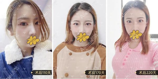 小姐姐在北京润美玉之光填充全脸5个月效果变化图.jpg 小姐姐在北京润美玉之光填充全脸5个月效果变化图.jpg