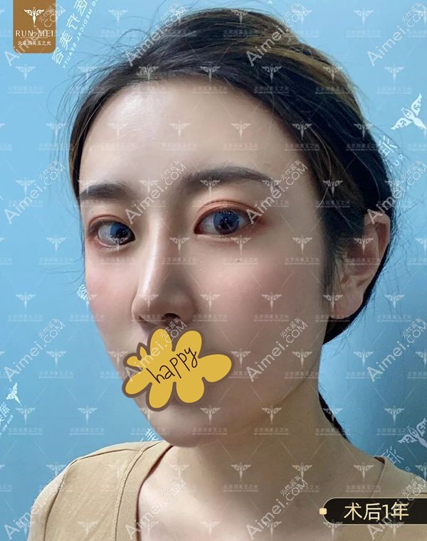 全脸脂肪填充50ml1年后效果图.jpg 全脸脂肪填充50ml1年后效果图.jpg