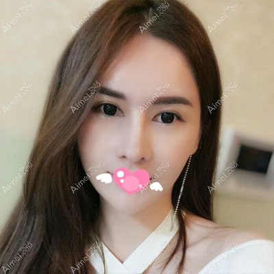 威宁硅胶假体+耳软骨隆鼻82天图片效果 威宁硅胶假体+耳软骨隆鼻82天图片效果