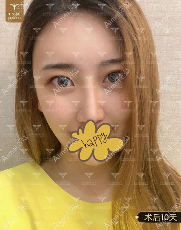 北京润美玉之光面部填充10天效果图.jpg 北京润美玉之光面部填充10天效果图.jpg