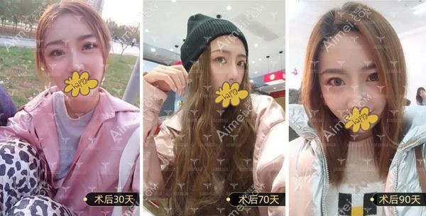 小姐姐在北京润美玉之光填充全脸3个月效果变化图.jpg 小姐姐在北京润美玉之光填充全脸3个月效果变化图.jpg