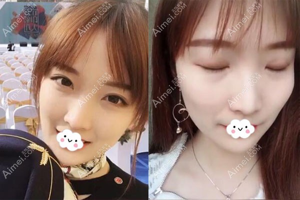 来看揭阳华美双眼皮术后120天闭眼效果怎么样 来看揭阳华美双眼皮术后120天闭眼效果怎么样