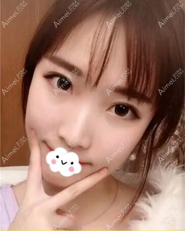 揭阳华美眼综合术后30天恢复效果图 揭阳华美眼综合术后30天恢复效果图