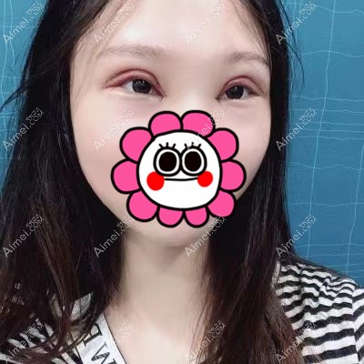 在武汉艾美做双眼皮和开眼角术后5天 在武汉艾美做双眼皮和开眼角术后5天