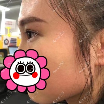 在武汉艾美做双眼皮和开眼角术后85天 在武汉艾美做双眼皮和开眼角术后85天