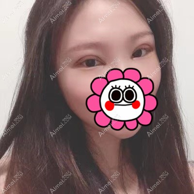 在武汉艾美做双眼皮和开眼角术后14天 在武汉艾美做双眼皮和开眼角术后14天