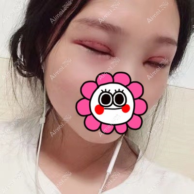 在武汉艾美做双眼皮和开眼角术后7天 在武汉艾美做双眼皮和开眼角术后7天