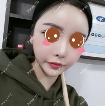 在武汉五洲莱美做脂肪填充术后1个月 在武汉五洲莱美做脂肪填充术后1个月