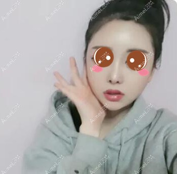 在武汉五洲莱美做脂肪填充术后10天 在武汉五洲莱美做脂肪填充术后10天