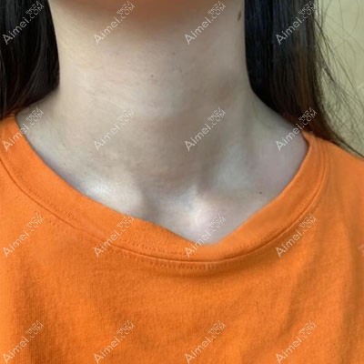 疤痕增生3个月变软变平 疤痕增生3个月变软变平