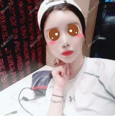 在武汉五洲莱美做脂肪填充术后2个月 在武汉五洲莱美做脂肪填充术后2个月