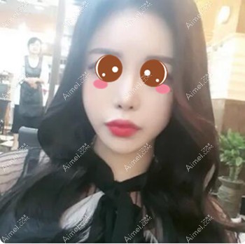 在武汉五洲莱美做脂肪填充术后3个月 在武汉五洲莱美做脂肪填充术后3个月