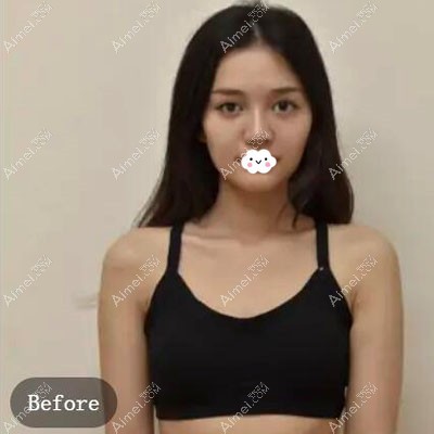 广州华美傲诺拉假体隆胸真人案例 广州华美傲诺拉假体隆胸真人案例