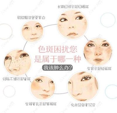 成都皮秒祛斑哪个医院好?军大祛斑类型 成都皮秒祛斑哪个医院好?军大祛斑类型