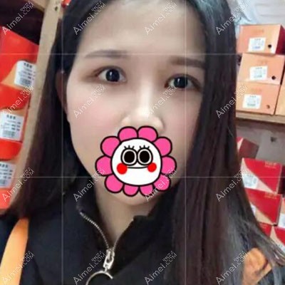 割双眼皮刀口凹陷疤痕修复23天恢复图 割双眼皮刀口凹陷疤痕修复23天恢复图