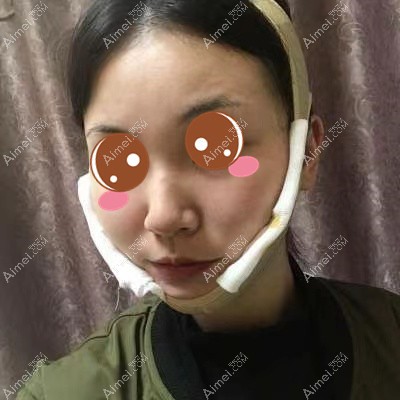 在武汉华美做颧骨下颌角术后2天 在武汉华美做颧骨下颌角术后2天