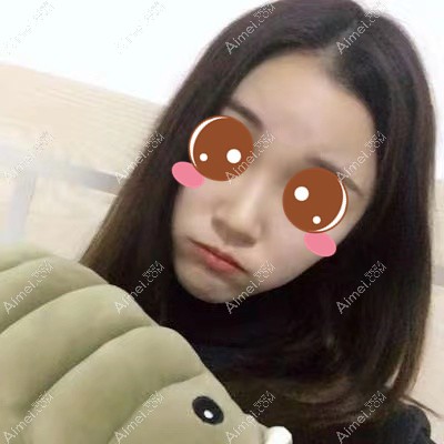 在武汉华美做颧骨下颌角术后10天 在武汉华美做颧骨下颌角术后10天