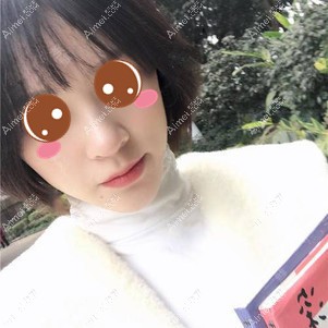 在襄阳悦美做鼻综合术后21天 在襄阳悦美做鼻综合术后21天