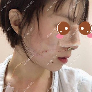 在襄阳悦美做鼻综合手术当天 在襄阳悦美做鼻综合手术当天