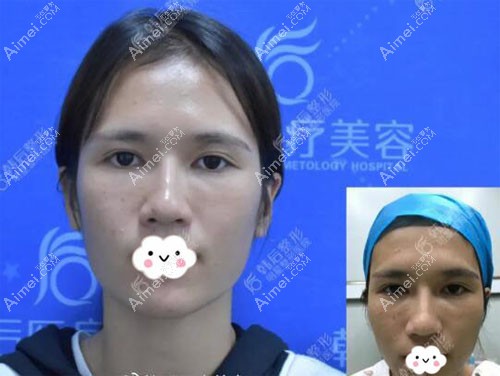 广州韩后崔东做鼻修复案例 广州韩后崔东做鼻修复案例