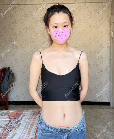 成都医大手术祛疤效果图 成都医大手术祛疤效果图