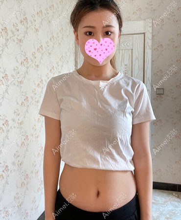 剖腹产疤痕增生手术方法很有效,去除很干净 剖腹产疤痕增生手术方法很有效,去除很干净